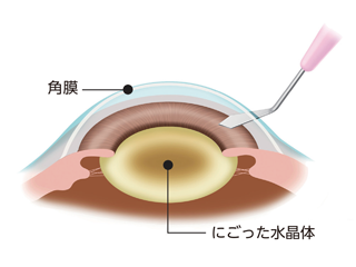 白内障手術01
